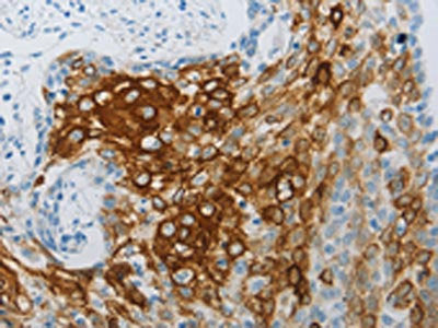 The image on the left is immunohistochemistry of paraffin-embedded Human cervical cancer tissue using CSB-PA235658(FLG Antibody) at dilution 1/30, on the right is treated with synthetic peptide. (Original magnification: X200)