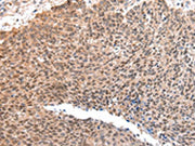 The image on the left is immunohistochemistry of paraffin-embedded Human lung cancer tissue using CSB-PA235670(ATF1 Antibody) at dilution 1/35, on the right is treated with synthetic peptide. (Original magnification: ×200)