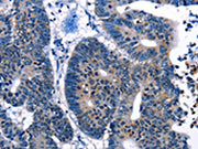 The image on the left is immunohistochemistry of paraffin-embedded Human cervical cancer tissue using CSB-PA235826(IRF7 Antibody) at dilution 1/10, on the right is treated with synthetic peptide. (Original magnification: ×200)