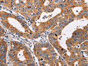 The image on the left is immunohistochemistry of paraffin-embedded Human gastic cancer tissue using CSB-PA235954(ADH1A Antibody) at dilution 1/25, on the right is treated with fusion protein. (Original magnification: ×200)