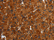The image on the left is immunohistochemistry of paraffin-embedded Human liver cancer tissue using CSB-PA235961(ENTPD7 Antibody) at dilution 1/40, on the right is treated with fusion protein. (Original magnification: ×200)