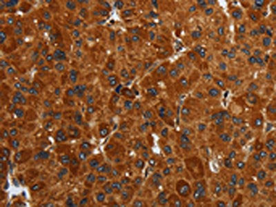 The image on the left is immunohistochemistry of paraffin-embedded Human liver cancer tissue using CSB-PA235961(ENTPD7 Antibody) at dilution 1/40, on the right is treated with fusion protein. (Original magnification: ×200)