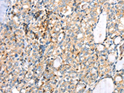 The image on the left is immunohistochemistry of paraffin-embedded Human thyroid cancer tissue using CSB-PA236161(MAGEB2 Antibody) at dilution 1/40, on the right is treated with synthetic peptide. (Original magnification: ×200)