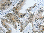 The image on the left is immunohistochemistry of paraffin-embedded Human colon cancer tissue using CSB-PA236497(KDM1A Antibody) at dilution 1/55, on the right is treated with synthetic peptide. (Original magnification: ×200)
