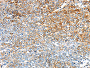 The image on the left is immunohistochemistry of paraffin-embedded Human ovarian cancer tissue using CSB-PA236753(TRIM47 Antibody) at dilution 1/30, on the right is treated with synthetic peptide. (Original magnification: ×200)