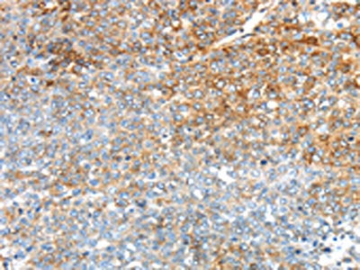 The image on the left is immunohistochemistry of paraffin-embedded Human ovarian cancer tissue using CSB-PA236753(TRIM47 Antibody) at dilution 1/30, on the right is treated with synthetic peptide. (Original magnification: ×200)