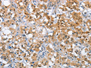 The image on the left is immunohistochemistry of paraffin-embedded Human thyroid cancer tissue using CSB-PA236767(MLH1 Antibody) at dilution 1/65, on the right is treated with fusion protein. (Original magnification: ×200)