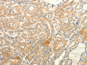 The image on the left is immunohistochemistry of paraffin-embedded Human thyroid cancer tissue using CSB-PA236814(TPH1 Antibody) at dilution 1/25, on the right is treated with fusion protein. (Original magnification: ×200)