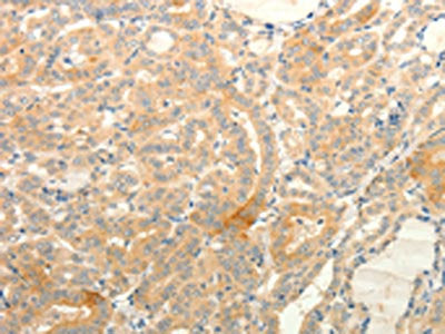The image on the left is immunohistochemistry of paraffin-embedded Human thyroid cancer tissue using CSB-PA236814(TPH1 Antibody) at dilution 1/25, on the right is treated with fusion protein. (Original magnification: ×200)