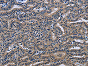 The image on the left is immunohistochemistry of paraffin-embedded Human thyroid cancer tissue using CSB-PA236888(KLHL2 Antibody) at dilution 1/20, on the right is treated with fusion protein. (Original magnification: ×200)