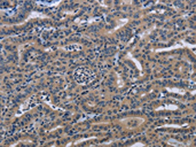 The image on the left is immunohistochemistry of paraffin-embedded Human thyroid cancer tissue using CSB-PA236888(KLHL2 Antibody) at dilution 1/20, on the right is treated with fusion protein. (Original magnification: ×200)
