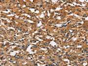 The image on the left is immunohistochemistry of paraffin-embedded Human thyroid cancer tissue using CSB-PA237032(BLK Antibody) at dilution 1/20, on the right is treated with fusion protein. (Original magnification: ×200)
