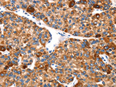The image on the left is immunohistochemistry of paraffin-embedded Human liver cancer tissue using CSB-PA237202(EPO Antibody) at dilution 1/25, on the right is treated with synthetic peptide. (Original magnification: ×200)
