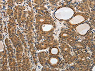The image on the left is immunohistochemistry of paraffin-embedded Human thyroid cancer tissue using CSB-PA237495(RARA Antibody) at dilution 1/40, on the right is treated with fusion protein. (Original magnification: ×200)