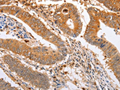The image on the left is immunohistochemistry of paraffin-embedded Human colon cancer tissue using CSB-PA237602(SERP1 Antibody) at dilution 1/20, on the right is treated with fusion protein. (Original magnification: ×200)