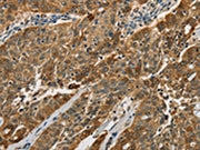The image on the left is immunohistochemistry of paraffin-embedded Human ovarian cancer tissue using CSB-PA237699(CTSE Antibody) at dilution 1/50, on the right is treated with fusion protein. (Original magnification: ×200)
