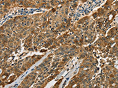 The image on the left is immunohistochemistry of paraffin-embedded Human ovarian cancer tissue using CSB-PA237699(CTSE Antibody) at dilution 1/50, on the right is treated with fusion protein. (Original magnification: ×200)