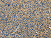 The image on the left is immunohistochemistry of paraffin-embedded Human liver cancer tissue using CSB-PA237733(TLR4 Antibody) at dilution 1/30, on the right is treated with fusion protein. (Original magnification: ×200)