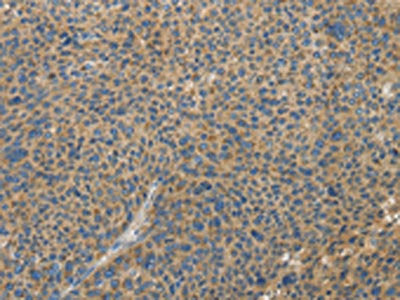 The image on the left is immunohistochemistry of paraffin-embedded Human liver cancer tissue using CSB-PA237733(TLR4 Antibody) at dilution 1/30, on the right is treated with fusion protein. (Original magnification: ×200)