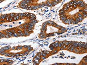 The image on the left is immunohistochemistry of paraffin-embedded Human colon cancer tissue using CSB-PA237804(CLDND1 Antibody) at dilution 1/60, on the right is treated with synthetic peptide. (Original magnification: ×200)