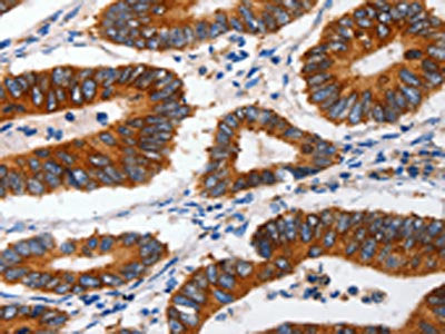 The image on the left is immunohistochemistry of paraffin-embedded Human colon cancer tissue using CSB-PA237804(CLDND1 Antibody) at dilution 1/60, on the right is treated with synthetic peptide. (Original magnification: ×200)