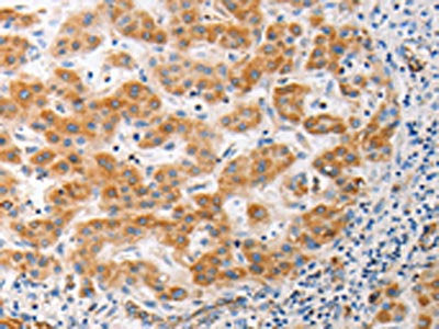 The image on the left is immunohistochemistry of paraffin-embedded Human liver cancer tissue using CSB-PA237856(MUC13 Antibody) at dilution 1/15, on the right is treated with synthetic peptide. (Original magnification: ×200)