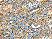 The image on the left is immunohistochemistry of paraffin-embedded Human breast cancer tissue using CSB-PA237947(DHCR24 Antibody) at dilution 1/40, on the right is treated with fusion protein. (Original magnification: ×200)