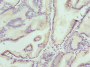 Immunohistochemistry of paraffin-embedded human prostate cancer using CSB-PA238099ESR2HU at dilution of 1:100