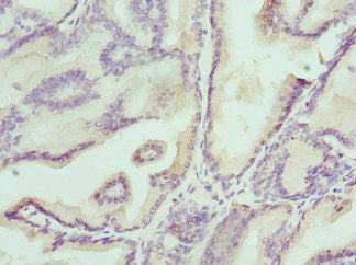 Immunohistochemistry of paraffin-embedded human prostate cancer using CSB-PA238099ESR2HU at dilution of 1:100