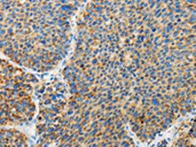 The image on the left is immunohistochemistry of paraffin-embedded Human liver cancer tissue using CSB-PA238135(ARHGEF3 Antibody) at dilution 1/25, on the right is treated with fusion protein. (Original magnification: ×200)