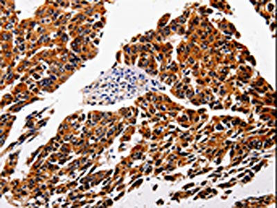 The image is immunohistochemistry of paraffin-embedded Human lung cancer tissue using CSB-PA238165(IL1RAP Antibody) at dilution 1/10. (Original magnification: ×200)