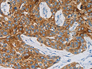 The image on the left is immunohistochemistry of paraffin-embedded Human esophagus cancer tissue using CSB-PA238244(NDRG4 Antibody) at dilution 1/60, on the right is treated with synthetic peptide. (Original magnification: ×200)