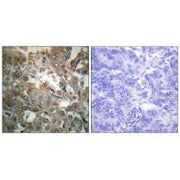 Immunohistochemistry analysis of paraffin-embedded human breast carcinoma tissue using XPA antibody.