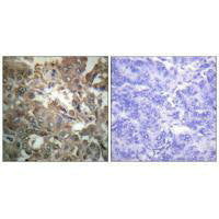 Immunohistochemistry analysis of paraffin-embedded human breast carcinoma tissue using XPA antibody.