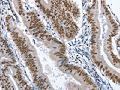 The image on the left is immunohistochemistry of paraffin-embedded Human colon cancer tissue using CSB-PA238659(GNRH1 Antibody) at dilution 1/70, on the right is treated with fusion protein. (Original magnification: ×200)