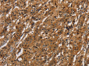 The image on the left is immunohistochemistry of paraffin-embedded Human gastic cancer tissue using CSB-PA238929(ICAM1 Antibody) at dilution 1/40, on the right is treated with fusion protein. (Original magnification: ×200)
