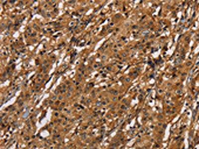 The image on the left is immunohistochemistry of paraffin-embedded Human gastic cancer tissue using CSB-PA238929(ICAM1 Antibody) at dilution 1/40, on the right is treated with fusion protein. (Original magnification: ×200)