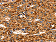 The image on the left is immunohistochemistry of paraffin-embedded Human liver cancer tissue using CSB-PA238975(TLN1 Antibody) at dilution 1/35, on the right is treated with synthetic peptide. (Original magnification: ×200)