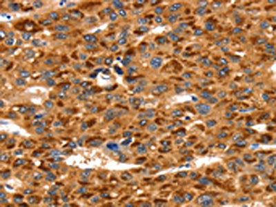 The image on the left is immunohistochemistry of paraffin-embedded Human liver cancer tissue using CSB-PA238975(TLN1 Antibody) at dilution 1/35, on the right is treated with synthetic peptide. (Original magnification: ×200)
