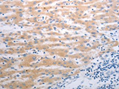 The image on the left is immunohistochemistry of paraffin-embedded Human liver cancer tissue using CSB-PA238998(PAK1 Antibody) at dilution 1/40, on the right is treated with synthetic peptide. (Original magnification: ×200)