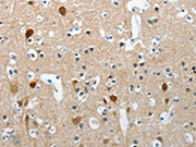 The image on the left is immunohistochemistry of paraffin-embedded Human brain tissue using CSB-PA239101(RCAN2 Antibody) at dilution 1/20, on the right is treated with synthetic peptide. (Original magnification: ×200)