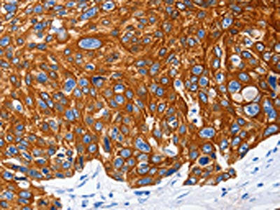 The image on the left is immunohistochemistry of paraffin-embedded Human esophagus cancer tissue using CSB-PA239200(NFATC1 Antibody) at dilution 1/25, on the right is treated with fusion protein. (Original magnification: ×200)