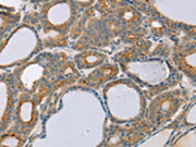 The image on the left is immunohistochemistry of paraffin-embedded Human thyroid cancer tissue using CSB-PA239255(SNX30 Antibody) at dilution 1/20, on the right is treated with synthetic peptide. (Original magnification: ×200)