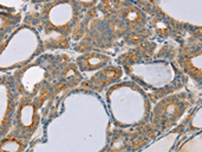 The image on the left is immunohistochemistry of paraffin-embedded Human thyroid cancer tissue using CSB-PA239255(SNX30 Antibody) at dilution 1/20, on the right is treated with synthetic peptide. (Original magnification: ×200)