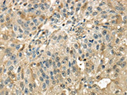 The image on the left is immunohistochemistry of paraffin-embedded Human breast cancer tissue using CSB-PA239298(RAB17 Antibody) at dilution 1/40, on the right is treated with synthetic peptide. (Original magnification: ×200)