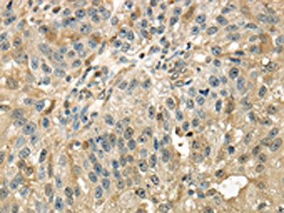 The image on the left is immunohistochemistry of paraffin-embedded Human breast cancer tissue using CSB-PA239298(RAB17 Antibody) at dilution 1/40, on the right is treated with synthetic peptide. (Original magnification: ×200)