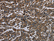 The image on the left is immunohistochemistry of paraffin-embedded Human liver cancer tissue using CSB-PA239383(GP1BA Antibody) at dilution 1/60, on the right is treated with fusion protein. (Original magnification: ×200)