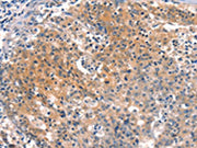 The image on the left is immunohistochemistry of paraffin-embedded Human gastic cancer tissue using CSB-PA239397(BFAR Antibody) at dilution 1/25, on the right is treated with synthetic peptide. (Original magnification: ×200)