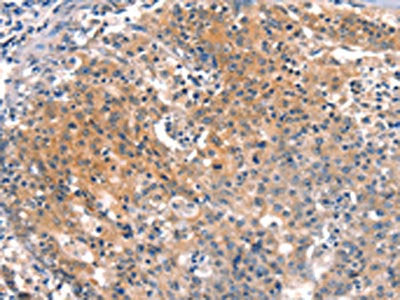 The image on the left is immunohistochemistry of paraffin-embedded Human gastic cancer tissue using CSB-PA239397(BFAR Antibody) at dilution 1/25, on the right is treated with synthetic peptide. (Original magnification: ×200)