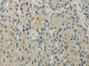 The image on the left is immunohistochemistry of paraffin-embedded Human liver cancer tissue using CSB-PA239457(RHOU Antibody) at dilution 1/30, on the right is treated with synthetic peptide. (Original magnification: ×200)